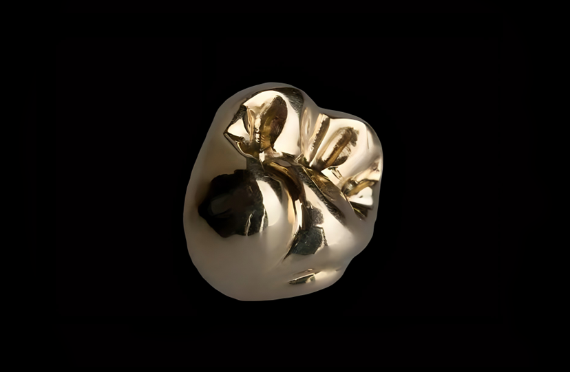 Full Gold Crown (FGC)